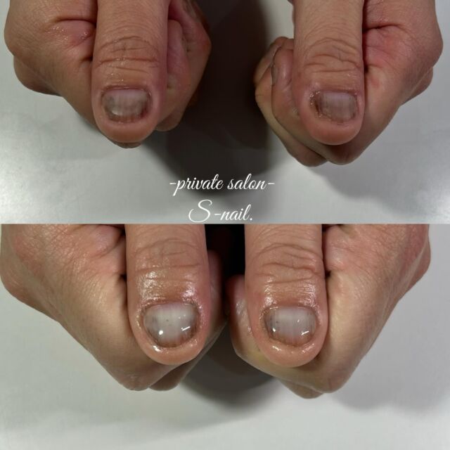 .
初回▷▶︎▷2回目施術後
————————————————————
‪

- 深爪矯正/自爪育成に特化したsalon -
.
深爪噛み癖むしり癖凹凸のあるお爪に
お悩みの方ぜひ一度ご相談ください。
.
.
▫️大阪/天王寺区　各線天王寺駅徒歩3分
▫️10:30〜18:00
▫️LINE  @855rjbic
▫️定休日⤑日曜日・月曜日

@fukazume_s_nail
@s_nail0601
private salon S-nail. 

————————————————————

#深爪矯正#深爪育成
#自爪育成#自爪育成サロン
#天王寺ネイルサロン